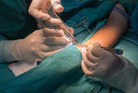  Fistula surgery